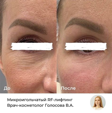 Как действует РФ лифтинг и влияет на состояние кожи