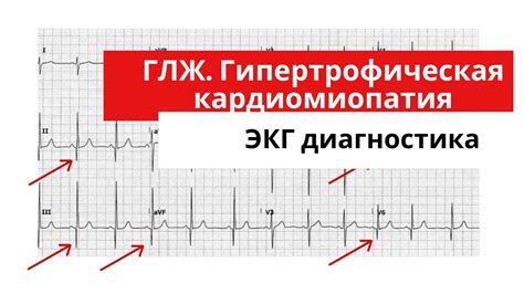 Как обнаружить изменения на ЭКГ у маленького пациента