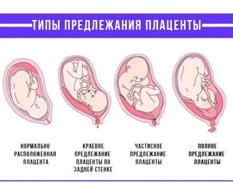 Как определить первую степень зрелости плаценты: особенности и способы оценки