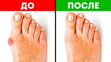 Как подобрать обувь, чтобы избежать повреждений мизинца на ноге