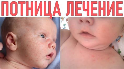 Как предотвратить появление раздражения на коже лица у младенца