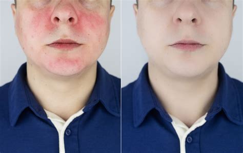 Как предотвратить раздражение и покраснение при очищении от зеленки