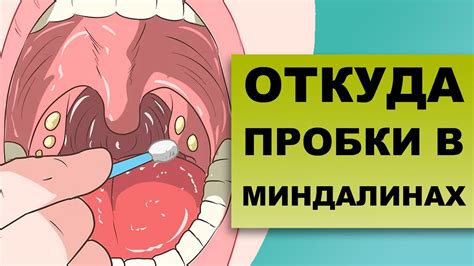 Как распознать казеозные пробки и какие проблемы они могут вызвать