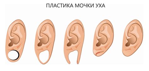 Как убрать украшение из уха, не ухудшая ситуацию