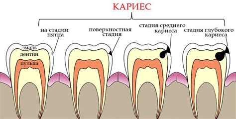 Кариес и полоскание полости рта