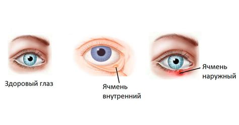 Кровоизлияние в глазе: симптомы и признаки