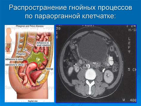 Лечение гнойного образования на ягодице: основные принципы и методы