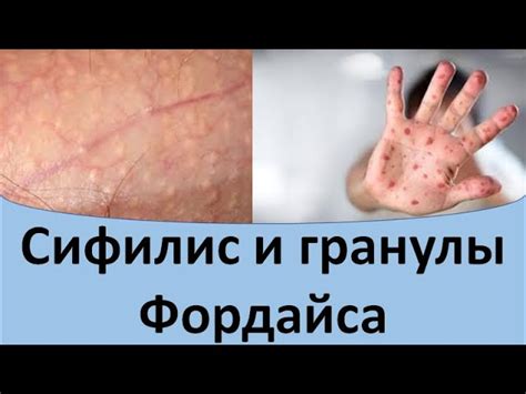 Лечение гранул Фордайса с помощью природных средств