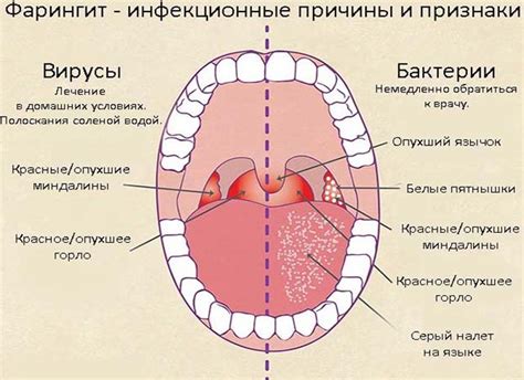 Медикаментозное воздействие для устранения гнойников в области горла у двухлетних детей