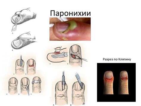 Методы домашнего лечения гнойных пальцев на ноге