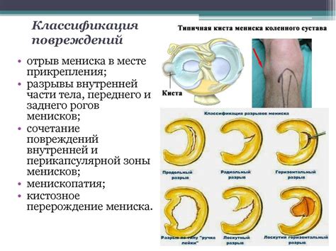 Механическое повреждение самого внутреннего элемента коленного соединения