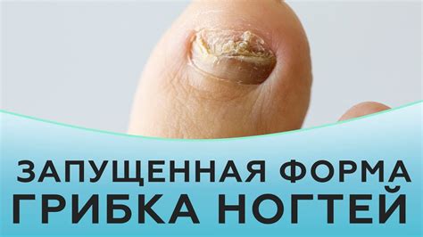 Мицелий грибка на ногтях: причины и способы передачи
