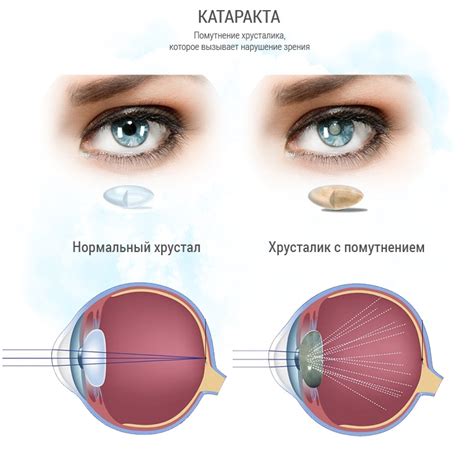 Назначение хрусталика при катаракте