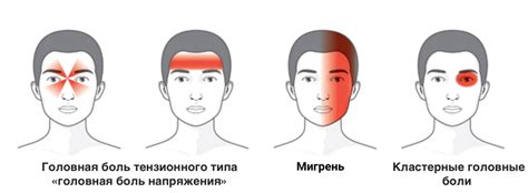Напряжение: причина хронической головной боли