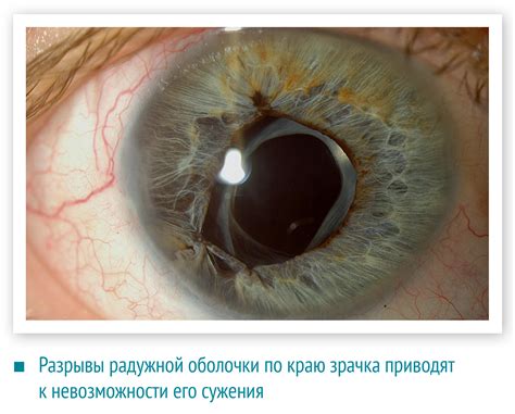 Натуральные средства для устранения проблемы с кровоизлиянием в сетчатке глаза
