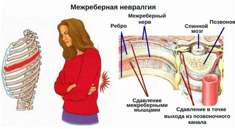 Невралгия межкостных нервов: источник боли и методы облегчения