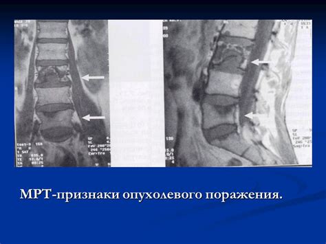 Обнаружение и признаки наличия сосудистого опухолевого образования в шестом шейном позвонке