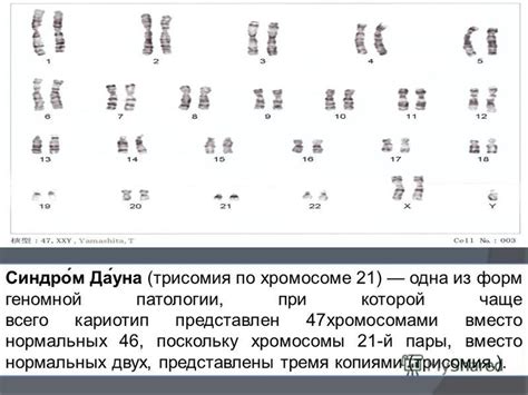 Образовательная нагрузка и особенности развития у индивидуумов с 47 хромосомами