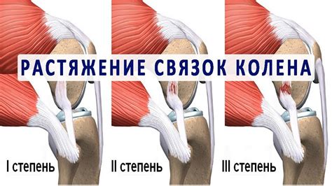 Ограничение подвижности колена