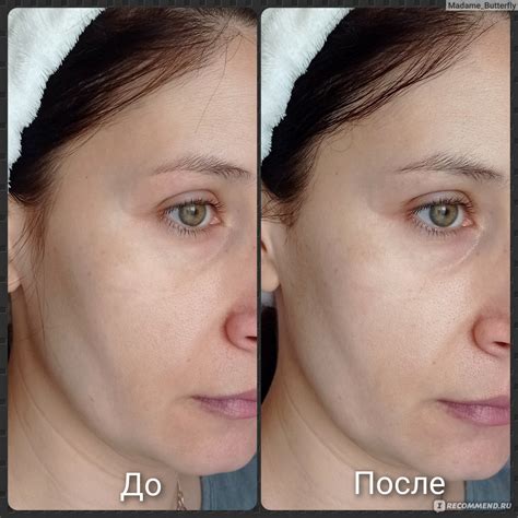 Омоложение и выравнивание тонуса кожи