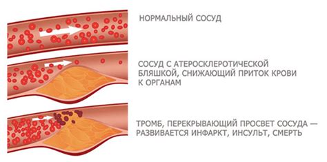 Опасность образования налета в кровеносных сосудах и их негативные последствия