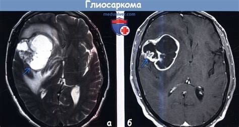 Определение и характеристики глиосаркомы