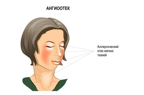 Определение орбитального отека и его причины