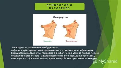 Определение острого лимфаденита