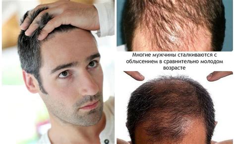 Определение причин облысения