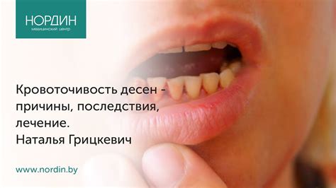 Опухоль и кровоточивость десен