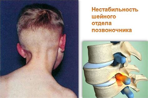 Осложнения при нестабильности шейных позвонков