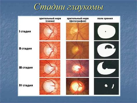 Осложнения узкоугольной глаукомы