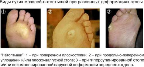 Основные признаки и причины возникновения сухих мозолей