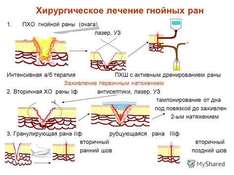 Основные принципы эффективного заживления гнойной раны у маленького пациента
