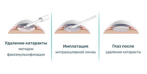 Основные требования к компонентам для создания искусственной хрусталика при лечении катаракты