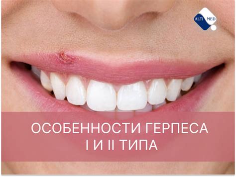 Особенности герпеса на периоральной зоне и методы его передачи