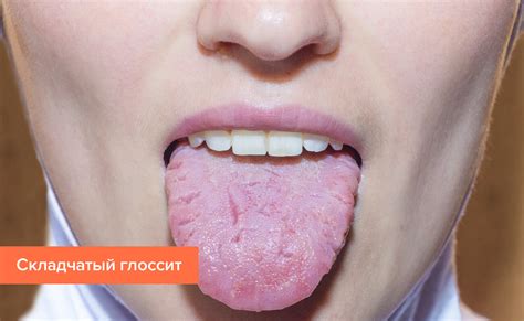 Особенности глоссит языка