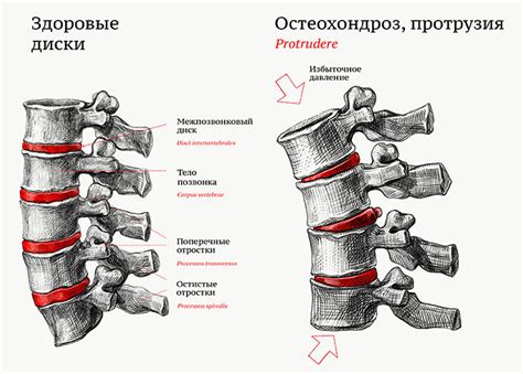 Остеохондроз: связь с болями в затылочной части слева