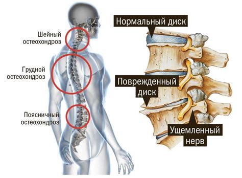 Остеохондроз и шейный остеохондроз
