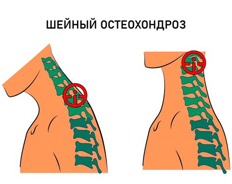 Остеохондроз шейного отдела позвоночника - проводник боли в голову