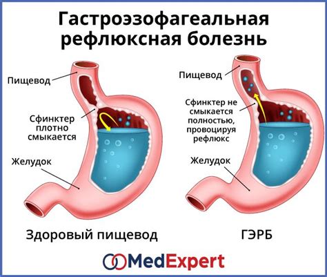 Отрицательные последствия гастроэзофагеального рефлюкса