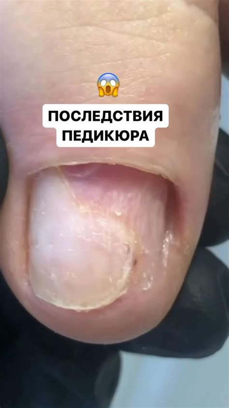 Ошибки при маникюре и педикюре, способствующие ломкости ногтей на ногах