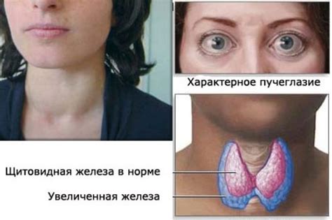 Патологическое увеличение щитовидной железы: основные аспекты