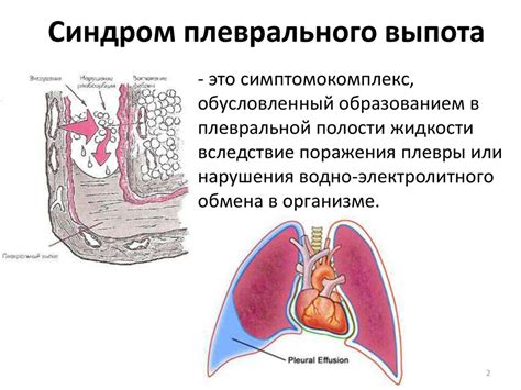 Плевральный выпот: понятие и классификация