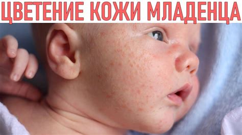 Подсказки для родителей: предотвращение и облегчение симптомов проблем с кожей у новорожденных