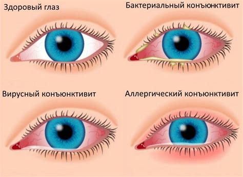 Покраснение глаза: Причины и симптомы