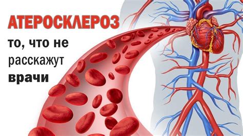 Понимание бляшек на сосудах шеи и головы