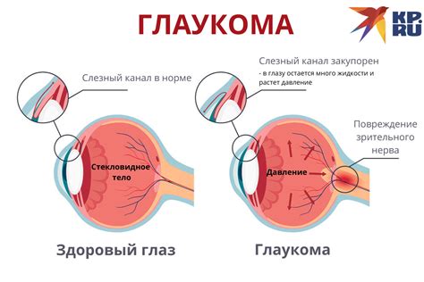 Понятие глаукомы и ее симптомы