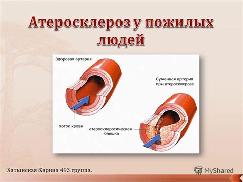 Понятие и возникновение атеросклеротических бляшек на стенках кровеносных сосудов