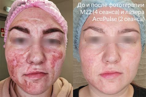 После ожога воском на лице: меры для облегчения состояния